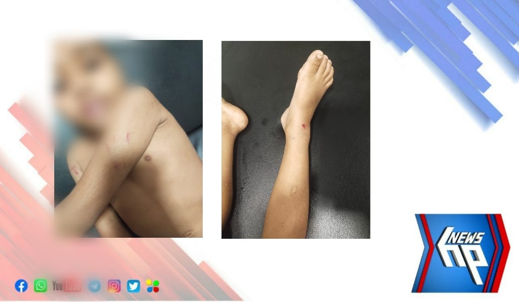 വക്കത്ത് നാല് വയസുകാരനെ വീടിനുള്ളിൽ കടന്ന് തെരുവ് നായ കടിച്ചു പരിക്കേൽപ്പിച്ചു