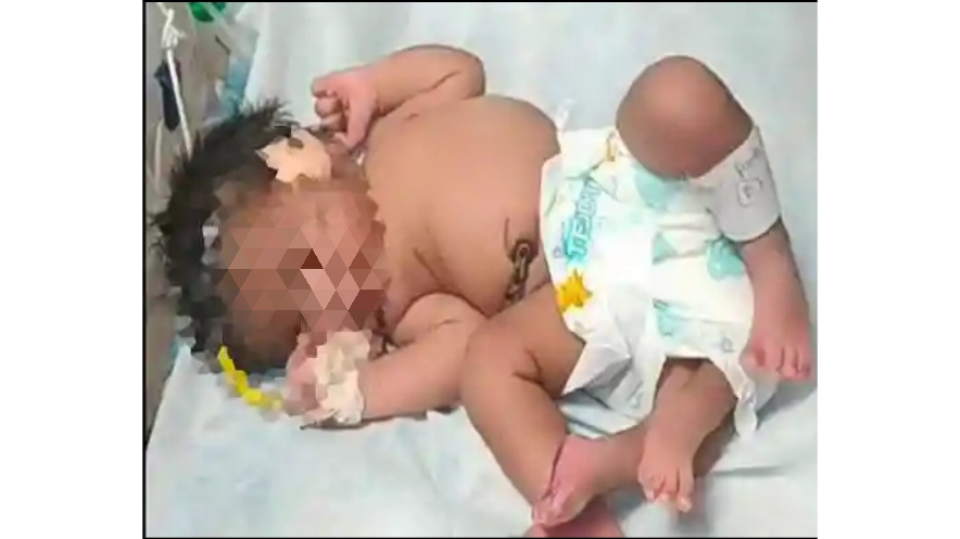നാലു കാലുമായി പെണ്‍കുഞ്ഞ് പിറന്നു; അപൂര്‍വം