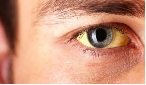 മലപ്പുറം വള്ളിക്കുന്നില്‍ മഞ്ഞപ്പിത്തം പടരുന്നു; സ്‌കൂളുകള്‍ക്ക് ജാഗ്രത നിര്‍ദേശം