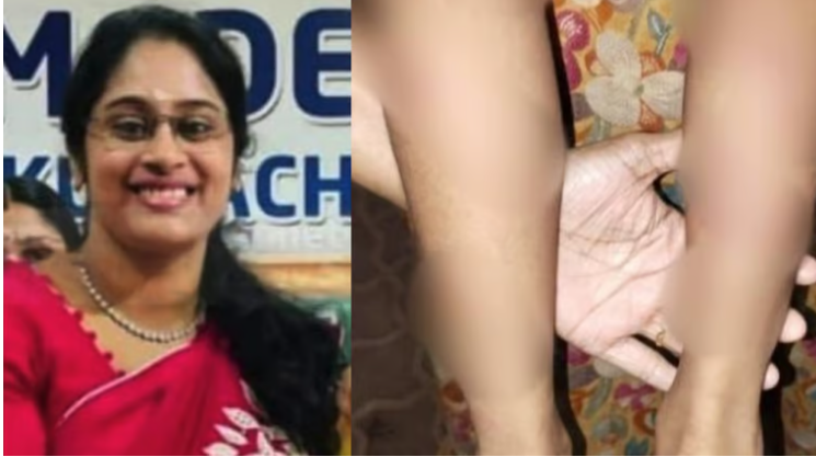 അഞ്ച് വയസുകാരനെ ക്രൂരമായി മര്‍ദിച്ച സംഭവം; അധ്യാപിക അറസ്റ്റില്‍
