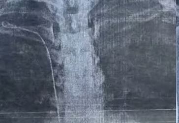 ചികിത്സക്കിടെ യുവതിയുടെ നെഞ്ചില്‍ ട്യൂബ് കുടുങ്ങി, റിപ്പോര്‍ട്ട് തേടി ഡിഎംഒ