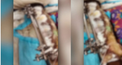 തിരുവനന്തപുരം മെഡിക്കൽ കോളേജിൽ രോഗിയുടെ കാലിൽ പുഴുവരിച്ച സംഭവം: ഡ്യൂട്ടി ഡോക്ടർക്ക് സസ്പെൻഷൻ