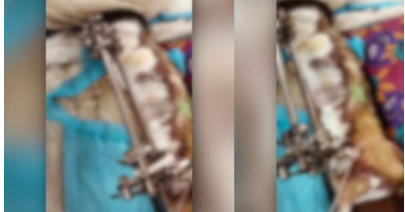 തിരുവനന്തപുരം മെഡിക്കൽ കോളേജിൽ രോഗിയുടെ കാലിൽ പുഴുവരിച്ച സംഭവം: ഡ്യൂട്ടി ഡോക്ടർക്ക് സസ്പെൻഷൻ