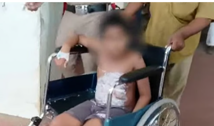 ദേഹമാസകലം പൊള്ളലേറ്റ് പത്തുവയസ്സുകാരന്‍; പൊള്ളിച്ചത് അച്ഛനെന്ന് കുട്ടി